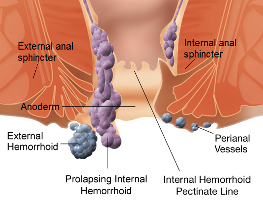 Hemorrhoids