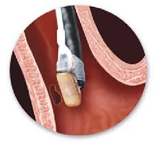 Radio frequency ablation