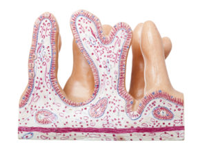 Celiac Disease Celiac Disease