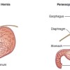 hiatal hernia lifestyle changes hiatal hernia lifestyle changes