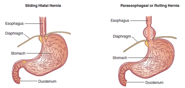 hiatal hernia lifestyle changes