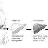 Fatty Liver GI Doctor Beverly Hills Fatty Liver GI Doctor Beverly Hills