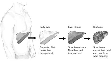 Fatty Liver GI Doctor Beverly Hills