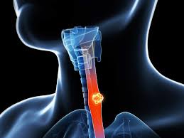 esophageal cancer test