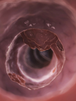 Colon and Rectal Polyps Colon and Rectal Polyps
