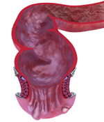 Hemorrhoids Crohn's Colitis
