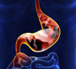 Stomach-Cancer1 SIBO
