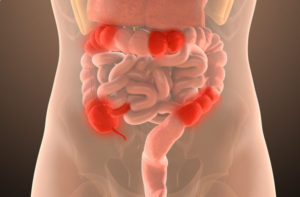 crohn’s colitis Crohn's Colitis