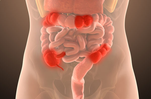 crohn’s colitis crohn's colitis