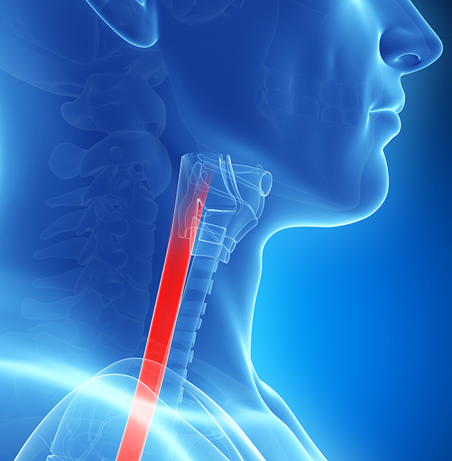 halo treatment for barrett's esophagus