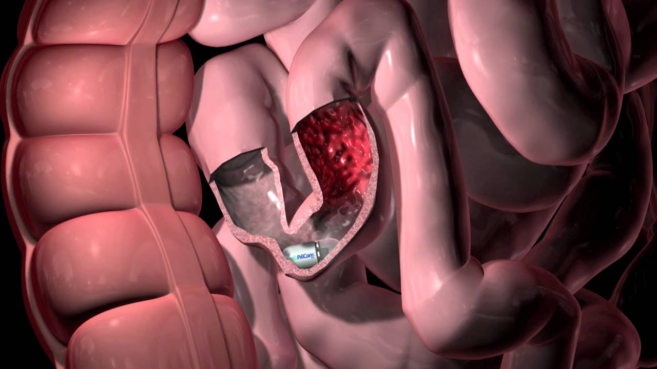 stomach pill camera
